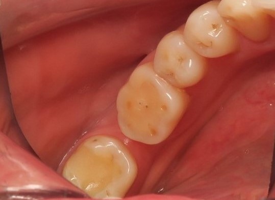 Генерализованная стираемость зубов