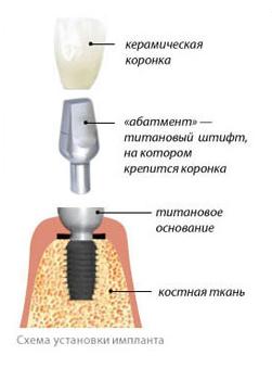 Имплантация зубов в Санкт-Петербурге