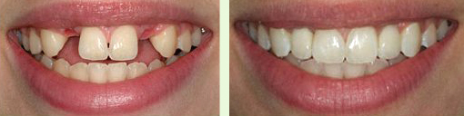 Имплантация зубов — ДО и ПОСЛЕ