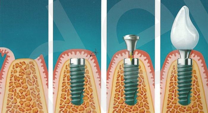Этапы имплантации зубов в «ТариДент»