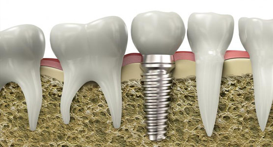 Зубные имплантаты «Ankylos»