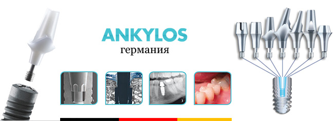 Зубные имплантаты «Ankylos»