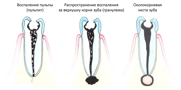 Лечение кисты зуба в стоматологии Санкт-Петербурга